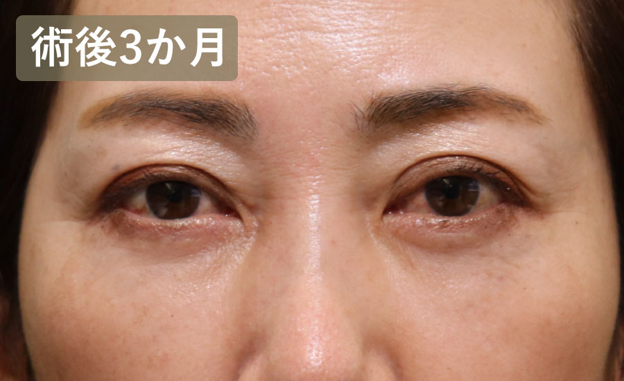 目の下のクマ取り・たるみ取り（ハムラ法）　症例4 After