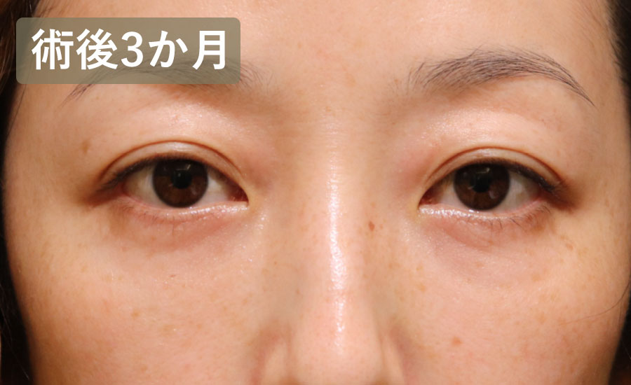 目の下のクマ取り・たるみ取り（ハムラ法）　症例1 After