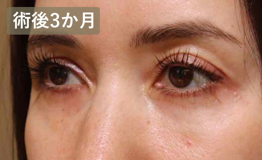 目の下のクマ取り・たるみ取り（ハムラ法）　症例3 After 2