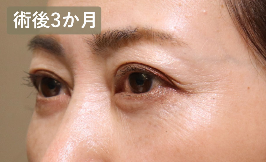 目の下のクマ取り・たるみ取り（ハムラ法）　症例4 After 2