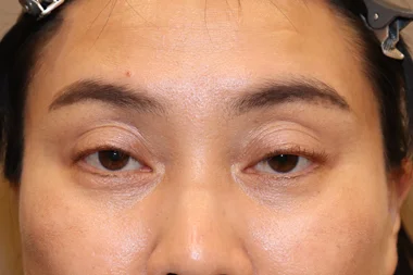 眼瞼下垂　症例19 Before