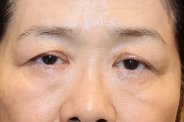 眼瞼下垂　症例20 Before