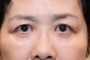 眼瞼下垂　症例20 After