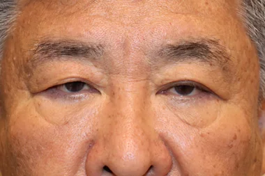 眼瞼下垂　症例21 Before