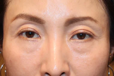 眼瞼下垂　症例22 Before