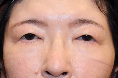 眼瞼下垂　症例23 Before