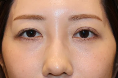 二重他院修正　症例24 Before
