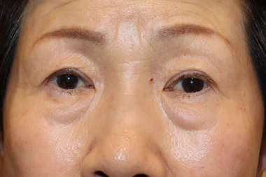 眼瞼下垂　症例25 Before
