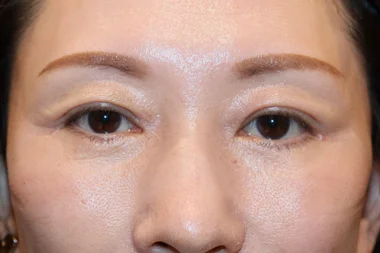 眼瞼下垂　症例26 Before