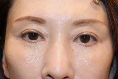 眼瞼下垂　症例26 After
