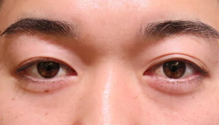 出目・はなれ目（眼球突出）　症例13 Before