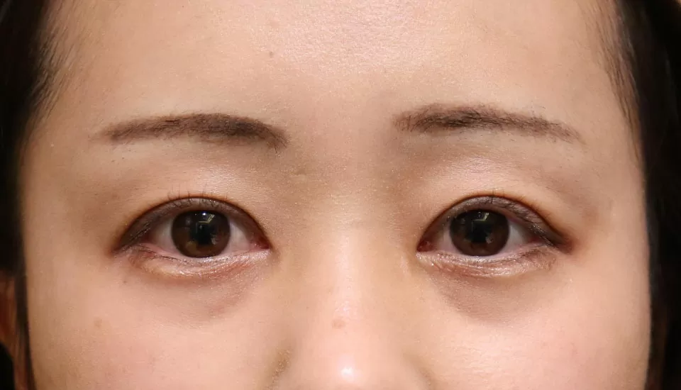 先天性眼瞼下垂　症例2 After