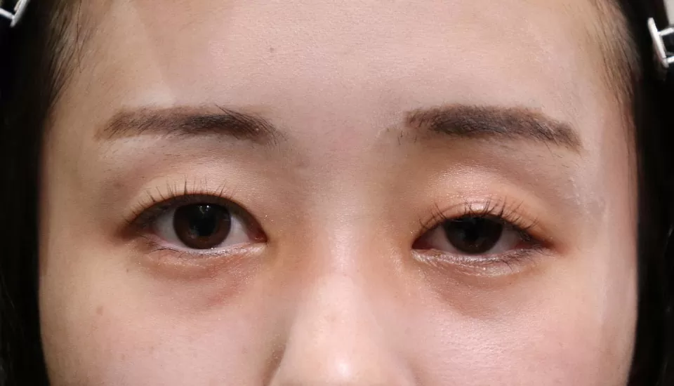 先天性眼瞼下垂　症例2 Before