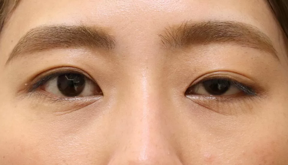 先天性眼瞼下垂　症例3 Before