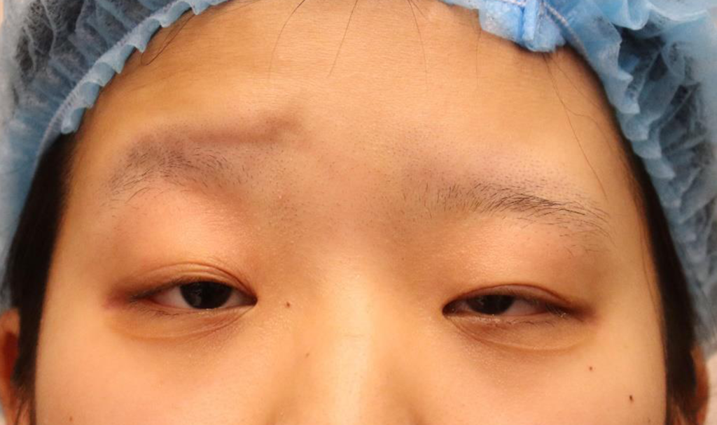 先天性眼瞼下垂　症例5 Before