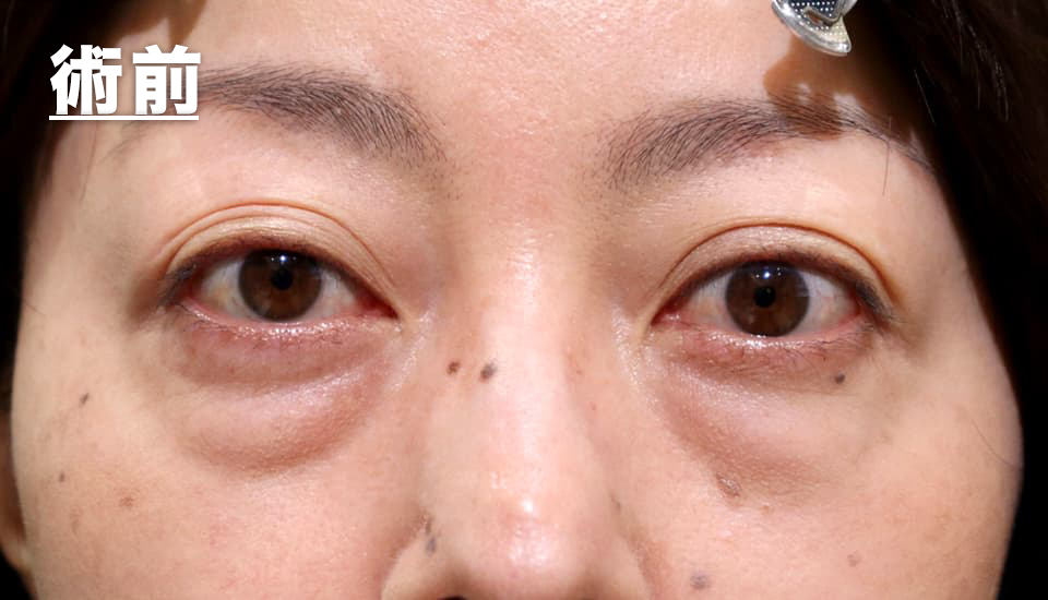 バセドウ病眼症・甲状腺眼症（目のクマ）　症例5 Before