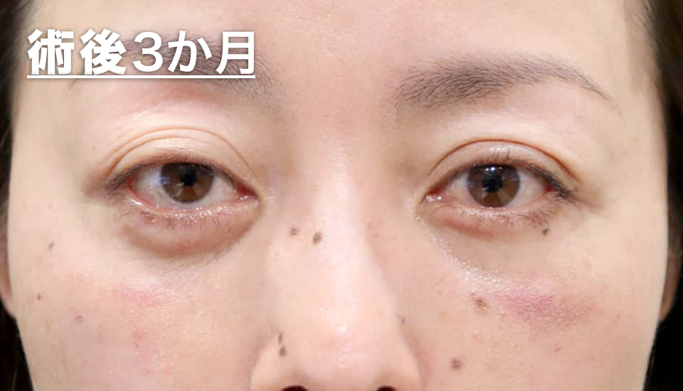 バセドウ病眼症・甲状腺眼症（目のクマ）　症例5 After