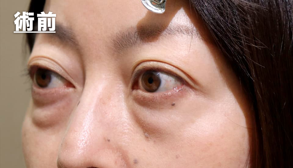 バセドウ病眼症・甲状腺眼症（目のクマ）　症例5 Before 2
