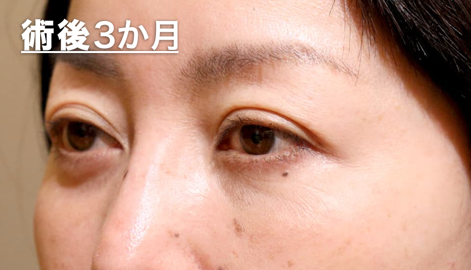 バセドウ病眼症・甲状腺眼症（目のクマ）　症例5 After 2