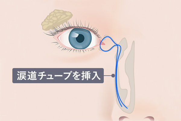 なみだ目に対する涙道内視鏡下涙管チューブ挿入術について