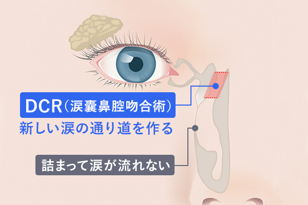 なみだ目に対する涙嚢鼻腔吻合術（DCR）について