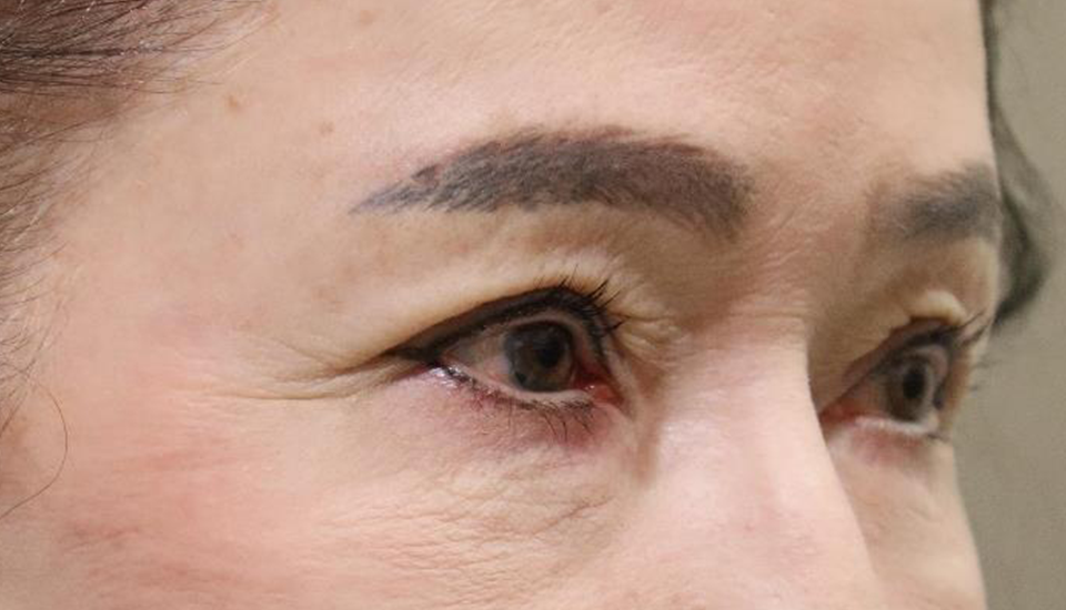 鼻の横じわ（バニーライン）に対する前額眉リフトの症例
