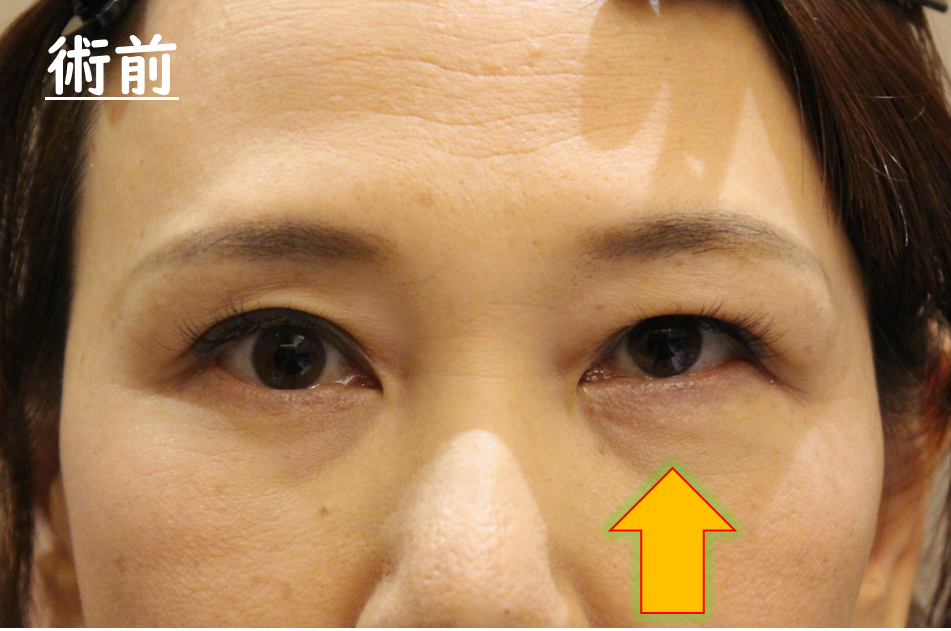 眼窩腫瘍摘出手術　症例3 Before