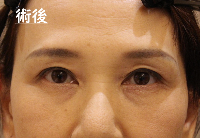 眼窩腫瘍摘出手術　症例3 After