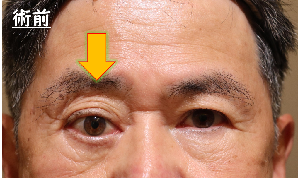 眼窩腫瘍摘出手術　症例4 Before