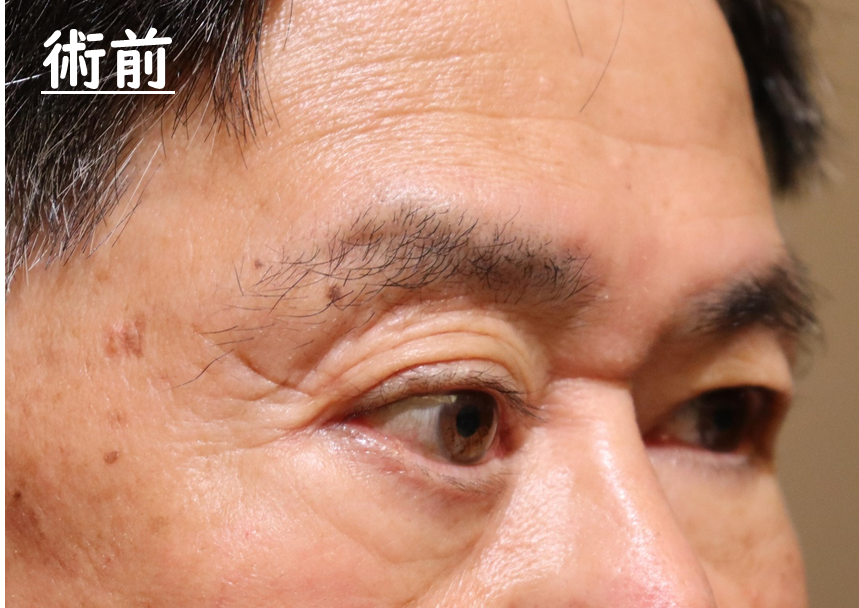 眼窩腫瘍摘出手術　症例4 Before 2