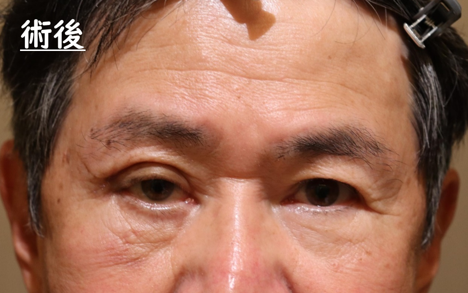 眼窩腫瘍摘出手術　症例4 After