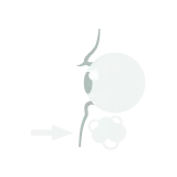 裏ハムラ法