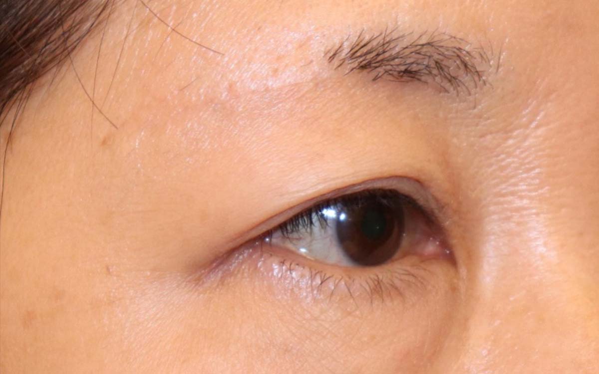 眼瞼下垂　症例10 After 2
