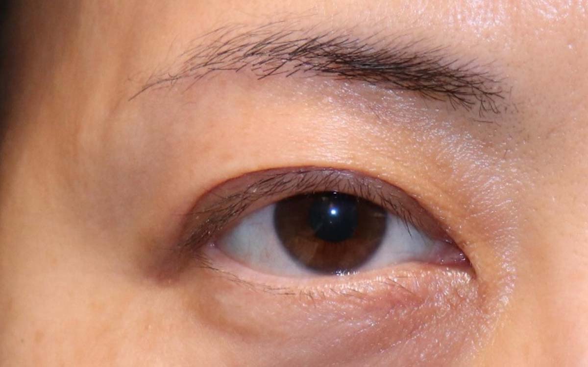 眼瞼下垂　症例11 After