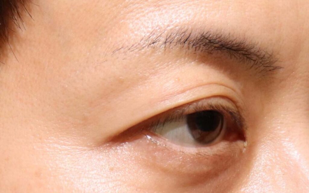 眼瞼下垂　症例11 Before