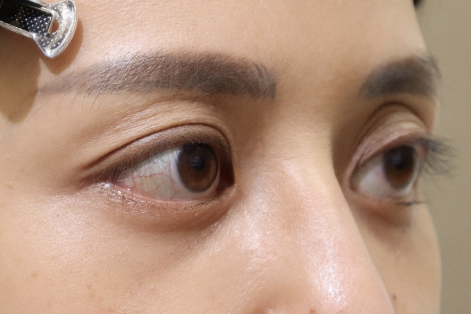 バセドウ病眼症・甲状腺眼症　症例14 After