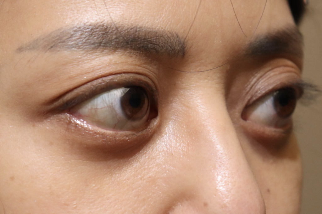 バセドウ病眼症・甲状腺眼症　症例14 Before