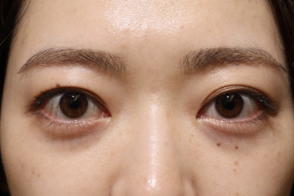 バセドウ病眼症・甲状腺眼症　症例16 Before