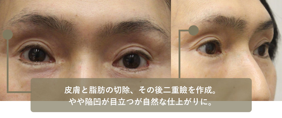 他院手術後修正　症例4 After