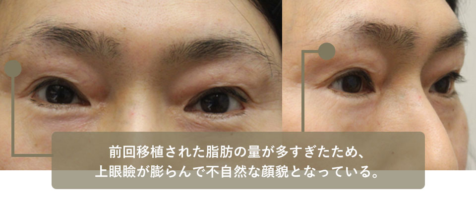 他院手術後修正　症例4 Before