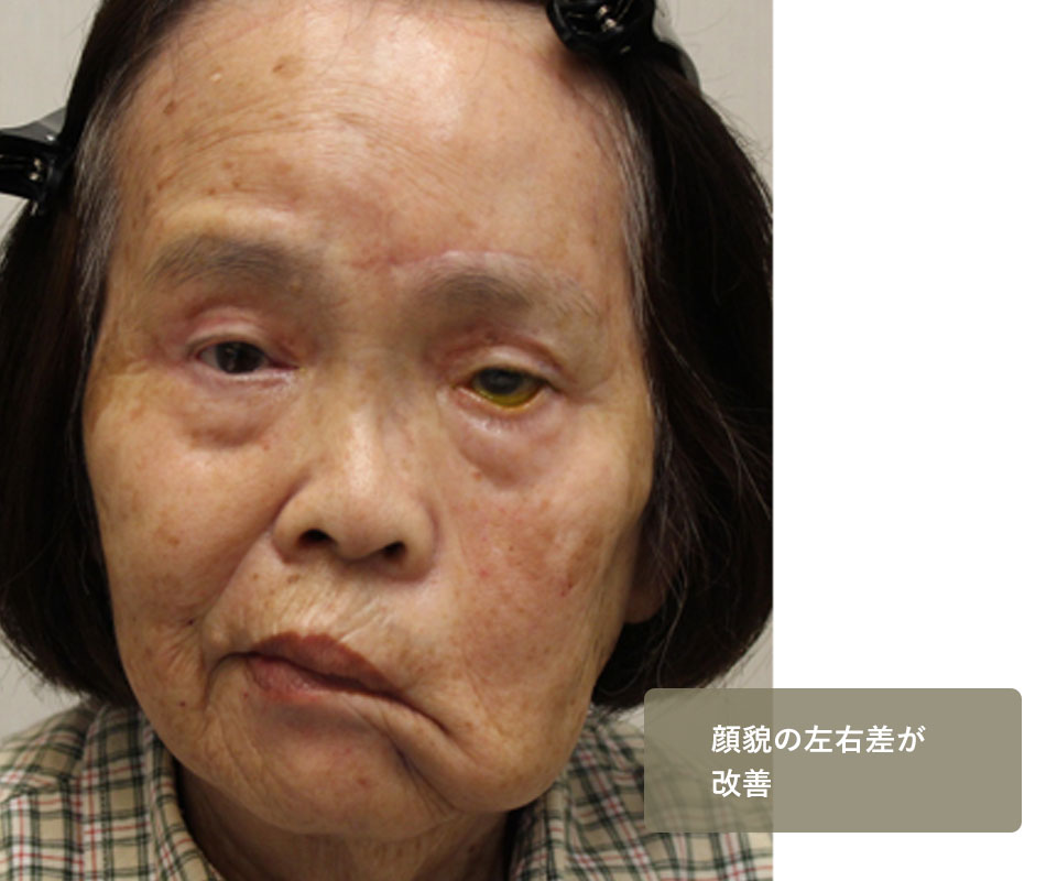 他院手術後修正　症例5 After