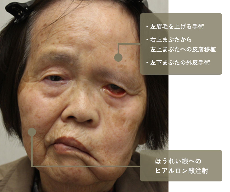 他院手術後修正　症例5 Before