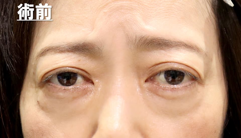 バセドウ病眼症・甲状腺眼症（目のクマ）　症例3 Before