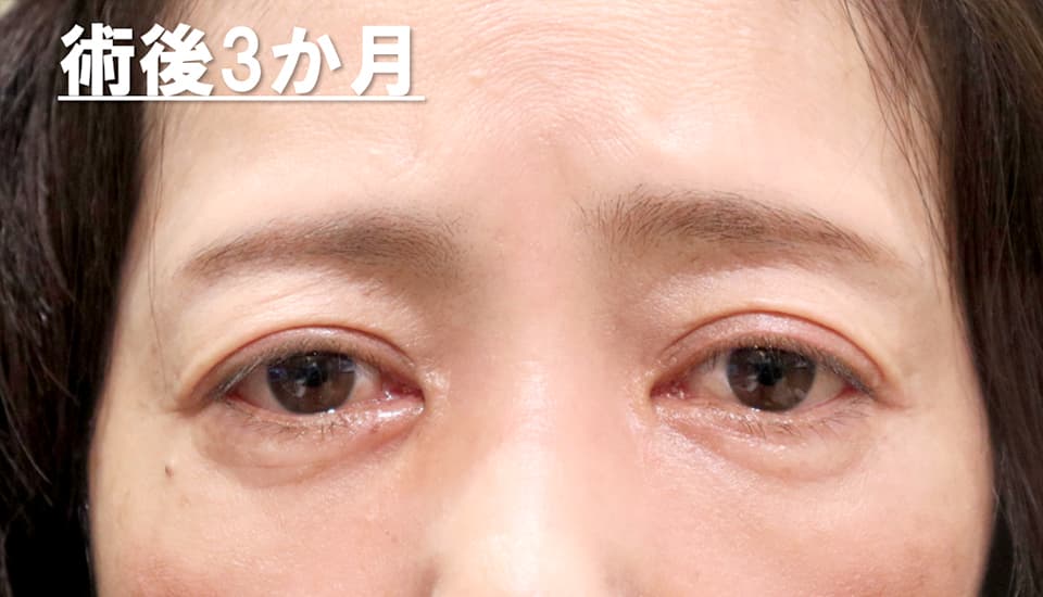 バセドウ病眼症・甲状腺眼症（目のクマ）　症例3 After