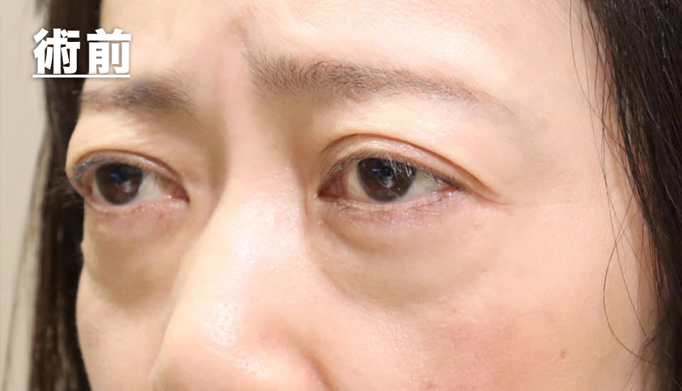 バセドウ病眼症・甲状腺眼症（目のクマ）　症例3 Before 2