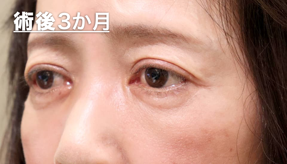 バセドウ病眼症・甲状腺眼症（目のクマ）　症例3 After 2