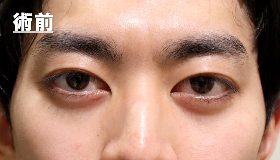 バセドウ病眼症・甲状腺眼症（目のクマ）　症例7 Before