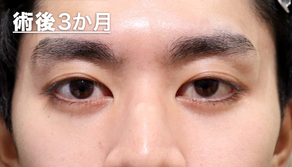 バセドウ病眼症・甲状腺眼症（目のクマ）　症例7 After