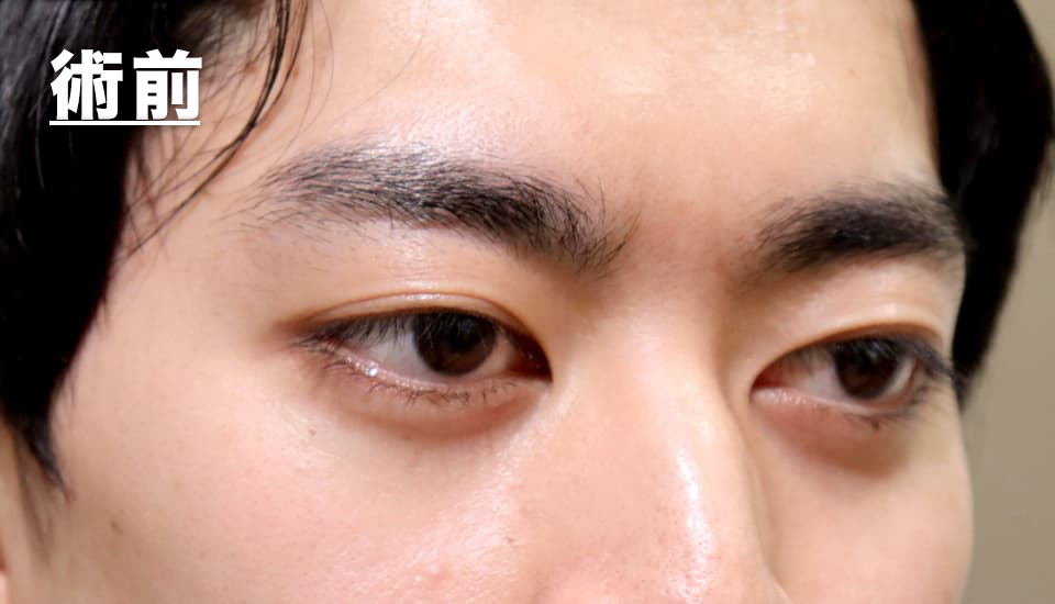 バセドウ病眼症・甲状腺眼症（目のクマ）　症例7 Before 2
