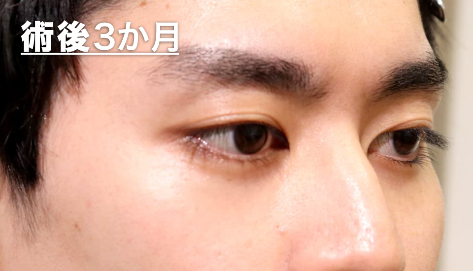 バセドウ病眼症・甲状腺眼症（目のクマ）　症例7 After 2